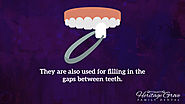• They are also used for filling in the gaps between teeth.