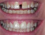 Tell us in brief what is diastema?