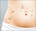 Liposuction - Information From WebMD