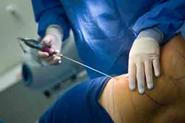 What Is Liposuction? Liposuction Risks And Benefits