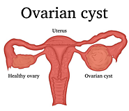 All you need to know and be aware about Ovarian Cyst!