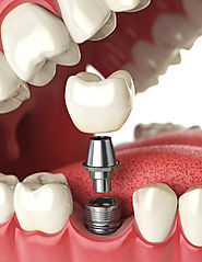 Dental Implants Dartford