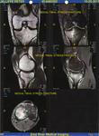 Stress fractures: A runner's guide