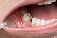 What Can You Do For Missing or Misaligned Teeth