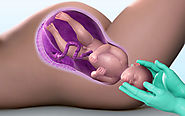 Top Uterus Removal Surgery in Bilaspur - Dr. Priya Mishra