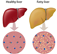Fatty Liver: What It Is, and How to Get Rid of It