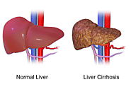 Department of Surgery - Fatty Liver Disease (Nonalcoholic Steatohepatitis)