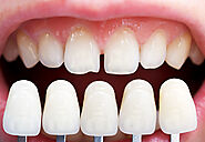 Choose to Get Cosmetic Dentistry in King of Prussia, PA