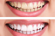 Can I Whiten My Teeth with Braces or Invisalign? | Masri Orthodontics