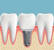Benefits and Price of Dental Implants: Ritesmile Dental