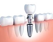 Benefits and Price of Dental Implants: Ritesmile Dental