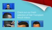 Hair Transplants | Hair Transplant Surgery | Hasson & Wong