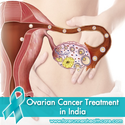 Low Cost Ovarian Cancer Treatment in India with Advanced Treatment Facilities
