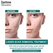 Laser scar removal treatment in Vadodara
