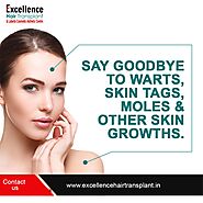 Say goodbye to warts, skin_tags, moles & other skingrowths.