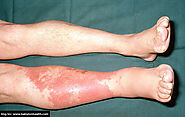 Safe Health PC - Things You Must Know To Curb Daunting Cellulitis