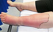 Cellulitis Doctor Specialist in Lansing and Mt. Pleasant