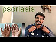 Psoriasis treatment in siddha, psoriasis treatment in siddha medicine in Tamil, best Ayurveda treatment for psoriasis...