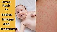 Hives Rash In Babies Treatment & Effective Home Remedy » Babyrashinfo