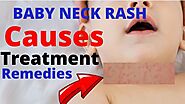 Baby Neck Rash, Causes, Treatment & Effective Remedies » Babyrashinfo