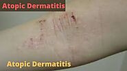 Newborn Baby With Atopic Dermatitis (Atopic Eczema): Which Creams Are Effective Effectively? » Babyrashinfo
