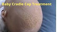 Natural Way Baby Cradle Cap Treatment & 4 Effective Home Remedies » Babyrashinfo