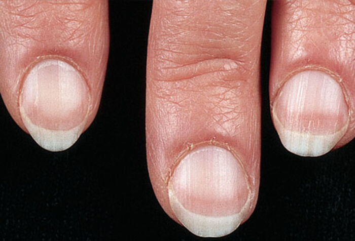 12-disease-signs-found-on-our-fingernails-a-listly-list