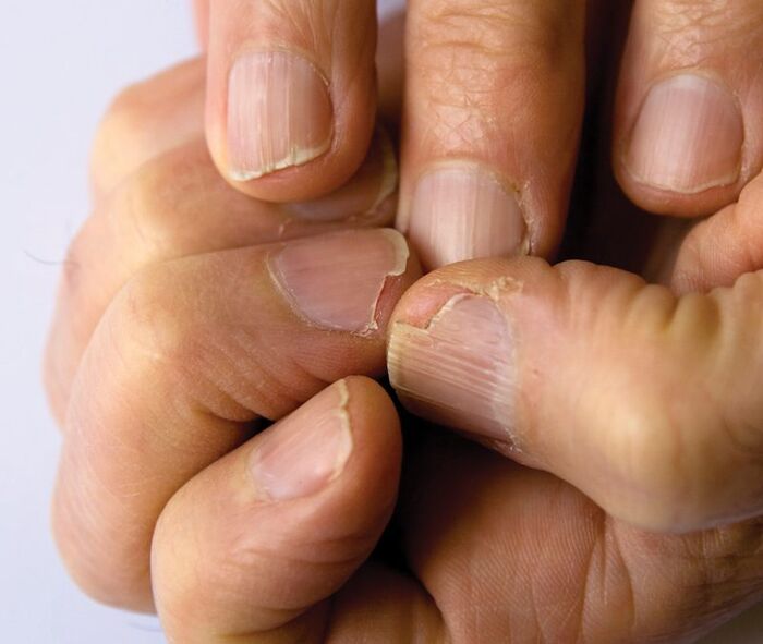 12 Disease Signs Found On Our Fingernails A Listly List   4747198 7 Split Or Cracked Nails 600px 