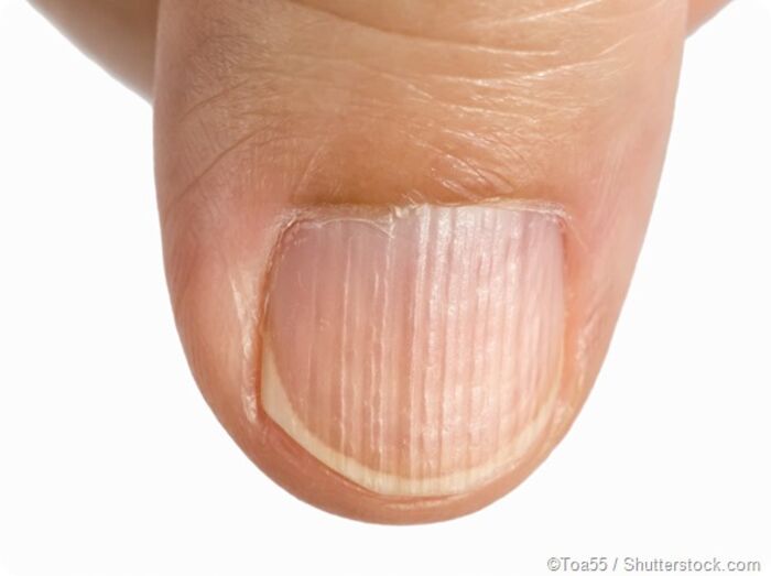 12 Disease Signs — Found On Our Fingernails | A Listly List