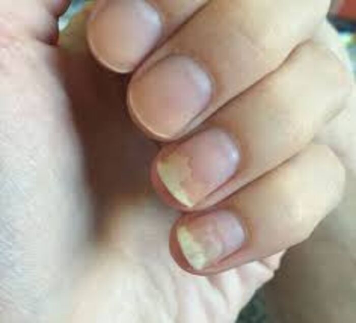 12 Disease Signs — Found On Our Fingernails A Listly List