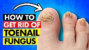 TOENAIL FUNGAL INFECTION : Best Home Remedies for Toenail Fungus