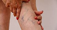 A Brief View of Varicose Veins and Spider Veins Followed by the Treatment Options