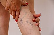 Sclerotherapy in Philadelphia Helps you to get rid of Abnormal Leg veins