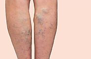 Treatment Options For Varicose Veins