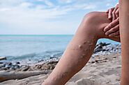 Do I Need Surgery For Varicose Veins?