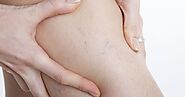 Let’s Know About Spider Veins And Their Advanced Treatments