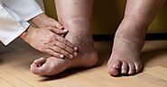 Why Do Vein Experts Suggest Sclerotherapy For Long-Term Relief?