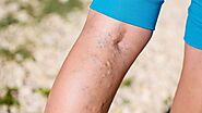 An In-Depth Look At The Different Aspects Of Varicose Veins Disease