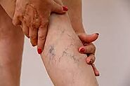 Addressing Basics of Varicose Veins And Its Treatment