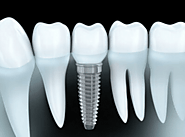 Full Mouth Dental Implants | Prime Dental