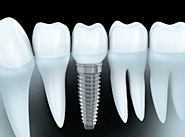 Dental Implants for All Teeth: Complete Smile Restoration