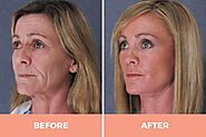 Get mini facelift Chicago services at the lowest possible cost
