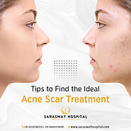 How to Find the Best Acne Scar Treatment for Yourself?