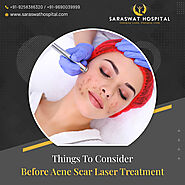 5 Things You Must Know Before Choosing Laser Acne Scar Treatment