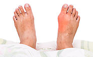 Best Gout Treatment in Delhi - Dr Jatinder Juneja