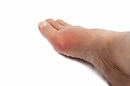 Key Tips on Preventing Bunions