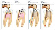 Root Canal Treatment in Mumbai is Painless | Spaceline Dental Studio
