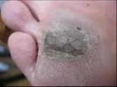 Wart Removal Home Remedies : Natural Wart Removal