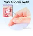 Warts: Treatment on Hands and Other Areas and Wart Causes