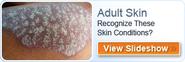 Plantar Warts Causes, Symptoms, Treatment - Home Remedies for Plantar Warts - eMedicineHealth